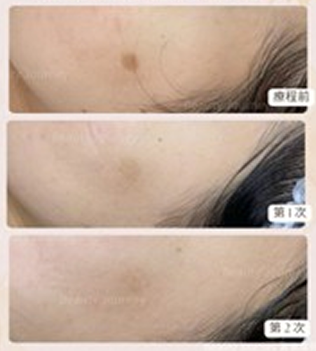PICO 美白去斑 1